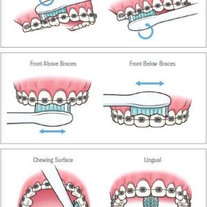 maintaining oral hygiene during orthodontic treatment 4
