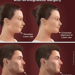 orthodontics and orthognathic surgery correcting jaw misalignment