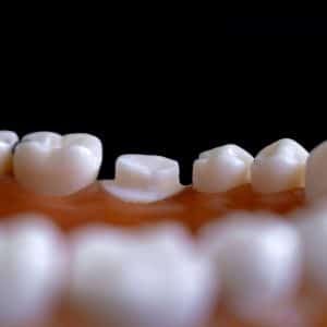 retainers and long term results of orthodontic treatment